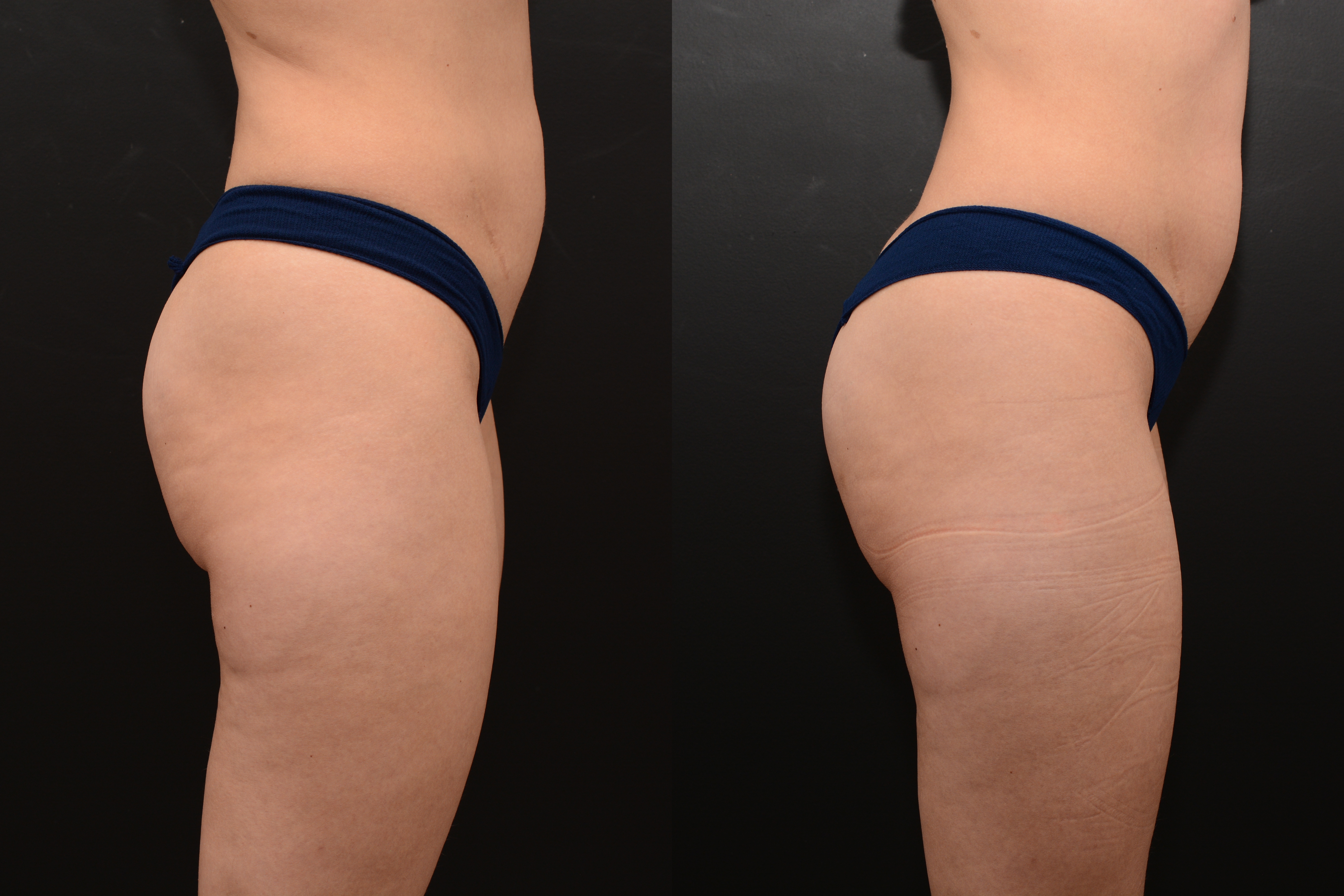 Emsculpt buttocks enhancement after 4 treatments - before and after